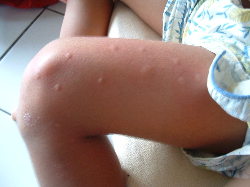 Mosquito bites on someones leg